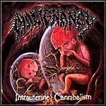 Malignancy - Intrauterine Cannibalism